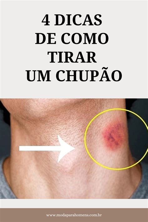 tirar chupada|Chupão: quando é bom, quais riscos pode trazer e como tirar